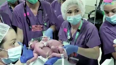 Israeli Doctors Separate Conjoined Twin Girls Youtube