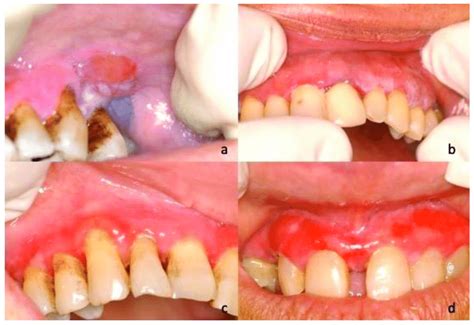 A Photograph Of 51 Year Old Male Blistering Lesion In The Upper Left