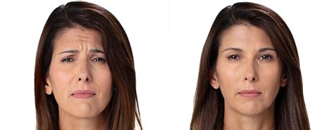 They will have two swabs taken 24 hours apart to check if they have cleared the virus. Botox & Dysport Melbourne | Winkle Reduction West ...