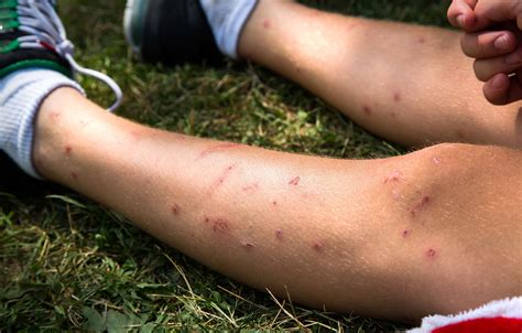 What To Know About Bee And Insect Stings Md Now Urgent Care