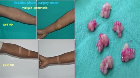 Having a lipoma surgically removed is more expensive. Lipoma Removal Surgery | Lipoma Treatment | Multiple ...
