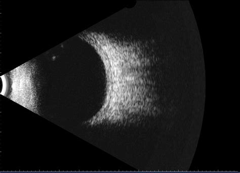 B Scan Ultrasound Of The Eye Retina Doctor Melbourne