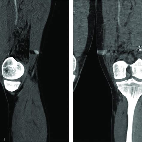Axial View Of Superficial Femoral Artery Sfa And Deep Femoral Artery