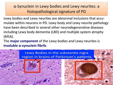 Ppt α Synuclein In Lewy Bodies And Lewy Neurites A
