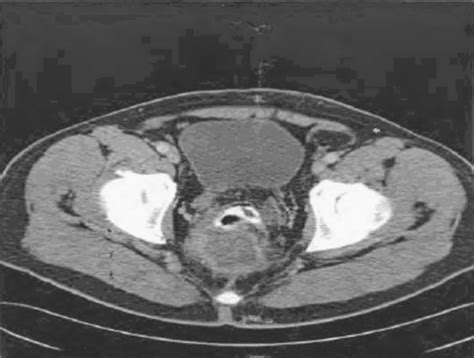 Ct Scan Showing A Heterogeneous Mass In The Dorsal Wall Of The Rectum