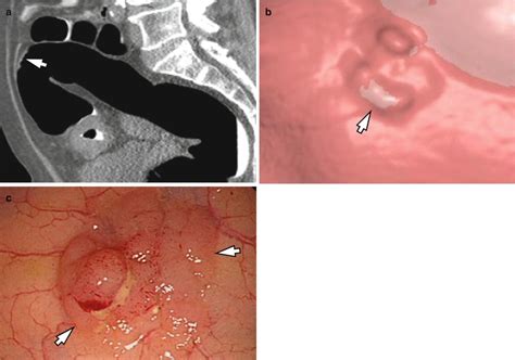 Benign Tumors Of The Colon Springerlink