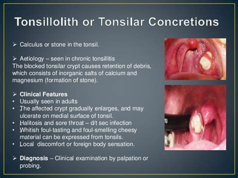 Anatomy Of The Tonsils Anatomical Charts And Posters