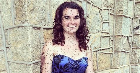 Girl With Hundreds Of Birthmarks Embraces Her Skin Popsugar Beauty