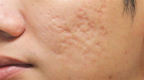 Boxcar Scars Home Treatments Causes And Outlook