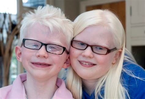 Oculocutaneous Albinism