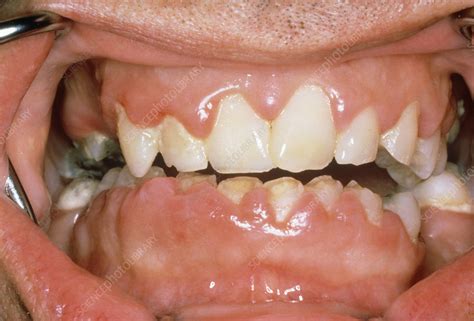 Mouth Showing Evidence Of Gingivitis Stock Image M7820030