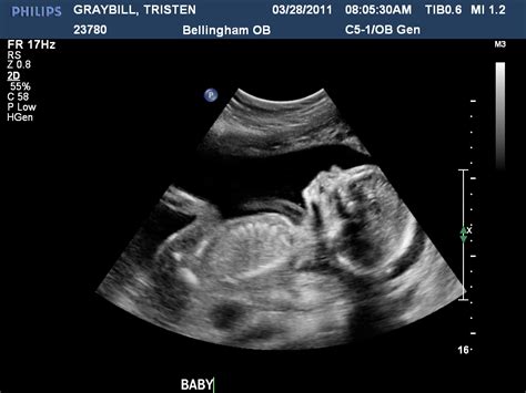 Inside Tristen 20 Week Ultrasound Its A Boy