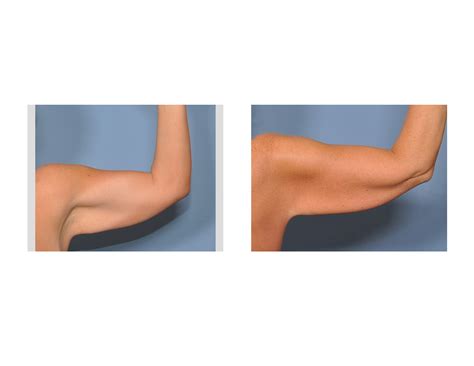 Saggy Arms Arm Ptosis Dr Barry Eppley Indianapolis1 Explore Plastic