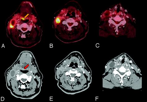 Fluorodeoxyglucosepositron Emission Tomography Imaging Of Head And