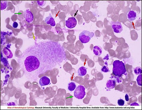 Chronic Myelomonocytic Leukaemia Type 0 Cmml 0 Cell Atlas Of