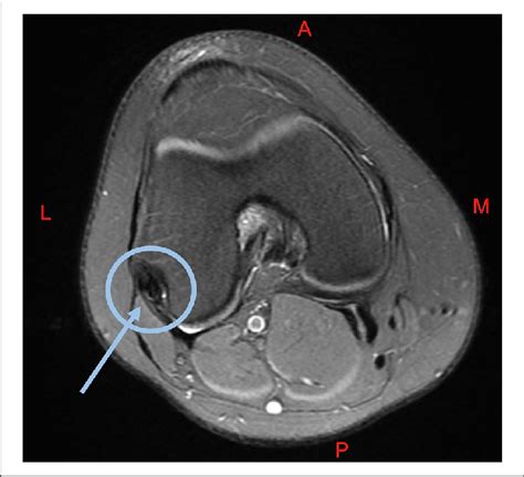 Axial Mri Of The Right Knee The Popliteus Is Visualized In The Blue