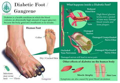 Diabetic Foot Gangrene Res Rehab