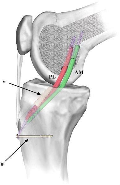 Depiction Of The Tibial Hybrid Fixation With An Extracortical