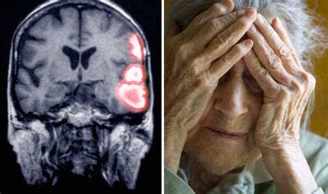 Stroke Victims More Likely To Develop Dementia Uk
