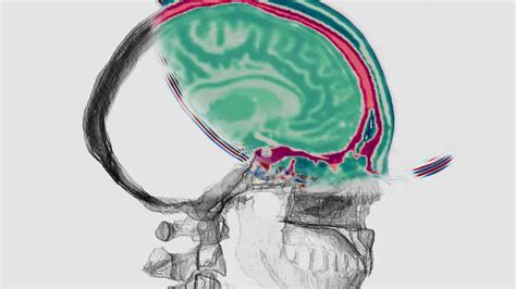 Combining Three Brain Imaging Techniques Boosts Precision Could Have