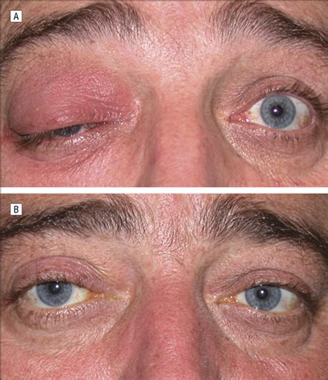 Idiopathic Sclerosing Orbital Inflammation Ophthalmology Jama