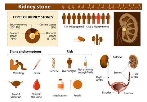 Nephrolithiasis Kidney Stones Sonographic Tendencies