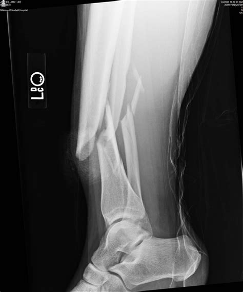 Image9 Compound Open Tib Fib Fracture 1 4 07 Amy A Flickr