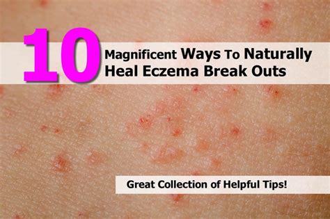 10 Magnificent Ways To Naturally Heal Eczema Break Outs Salud Natural