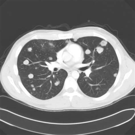 How To Read A Chest Ct Scan With Contrast