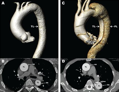 Frontiers The Role Of Macrophages In Aortic Dissection