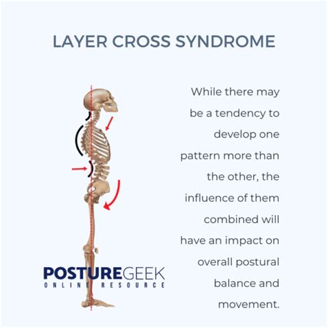 Janda Upper And Lower Cross Syndromes