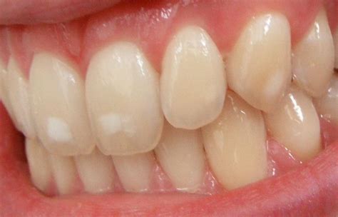 White Spots On Teeth 11 Tips On How To Get Rid Of Them