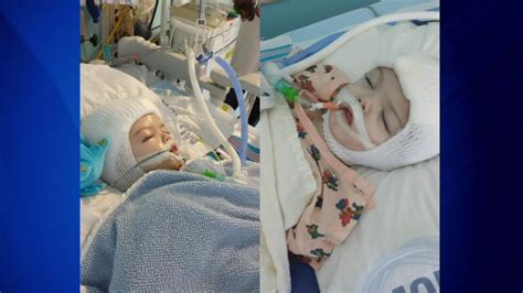 Separated Conjoined Twins Stable After Weekend Of Post Surgery