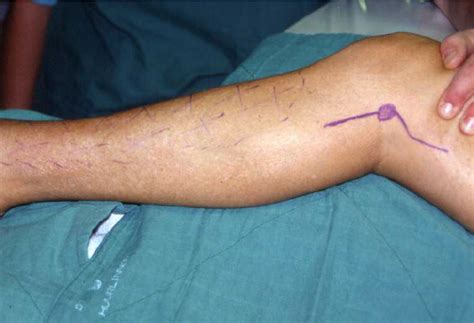 Incision For Peroneal Nerve Decompression Dotted Line Shows The Region