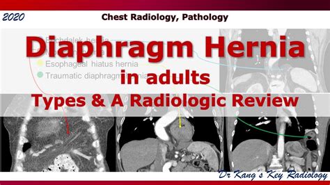 Diaphragm Hernia In Adults Types And A Radiologic Review Youtube