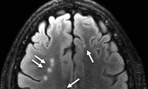 Mri Shows Brain Scars In Military Personnel With Blast Related Concussion