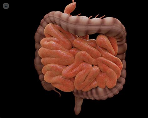 Fistula Management Of Anal Fistula The Bmj A Fistula Is A Permanent