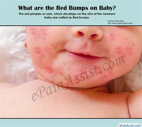 Red Bumps On Babycausessymptomstreatmentprognosisprevention