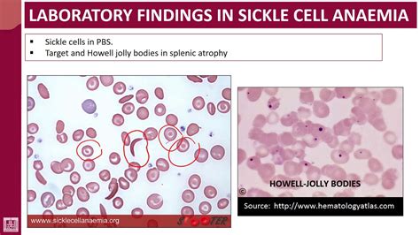 Hematology 2 U1 L27 Pbs Of Sickle Cell Anaemia Youtube