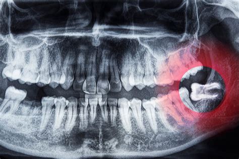 Everything You Ever Wanted To Know About Wisdom Teeth Dr Elston Wong