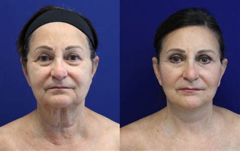 An Overview Of Facelift Incision Lines And Scars Jason Cooper Md