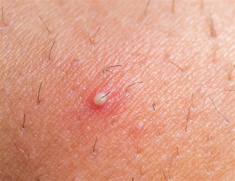 Causes And Symptoms Of Folliculitis Facty Health