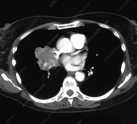 Lung Cancer Ct Stock Image C0394181 Science Photo Library