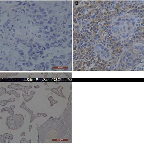 Representative Photographs Of Pd L1 Immunostaining In Esophageal