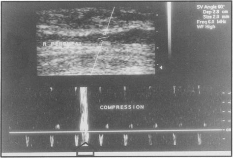 Longitudinal Image Depicting The Peroneal Vein The Doppler Gate Has