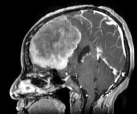 Giant Meningioma In Skull Radiograph Bmj Case Reports