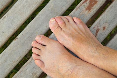 How To Treat A Bunionette On Your Pinky Toe The Orthopaedic Foot