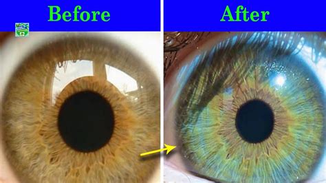 How To Lighten Eye Colour With Honey