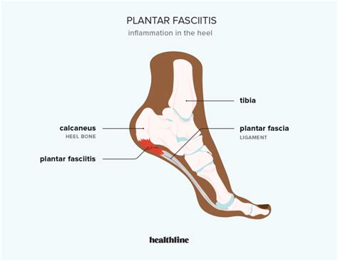 Plantar Fasciitis Heel Pain Renaissance Foot And Ankle Center Pc