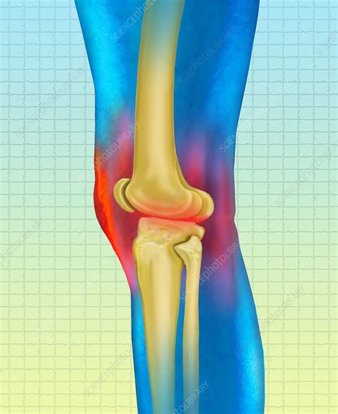 Knee Arthritis Stock Image C0249734 Science Photo Library